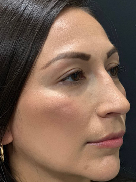 Rhinoplasty before and after - after
