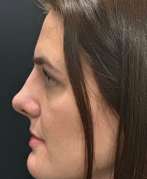 Rhinoplasty before and after - after