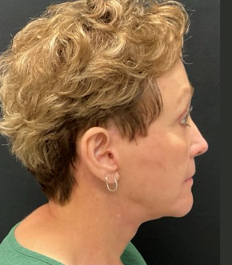 Facelift before and after - after