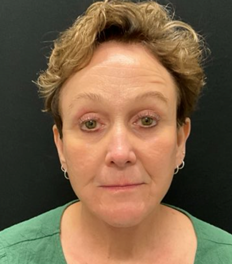 Facelift before and after - after