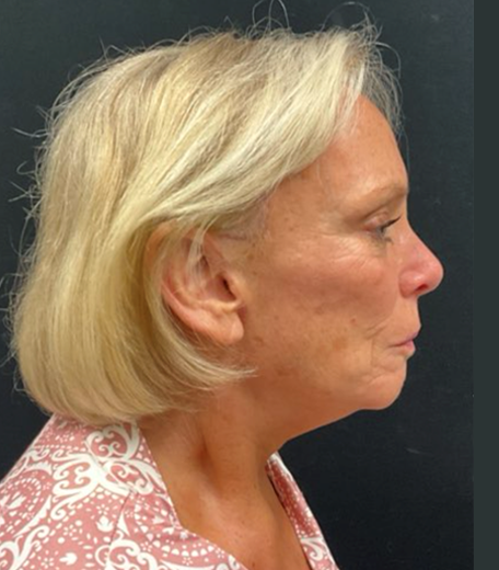 Facelift before and after - after