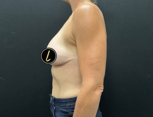 Breast Revision before and after - after