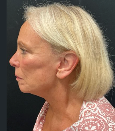 Facelift before and after - after