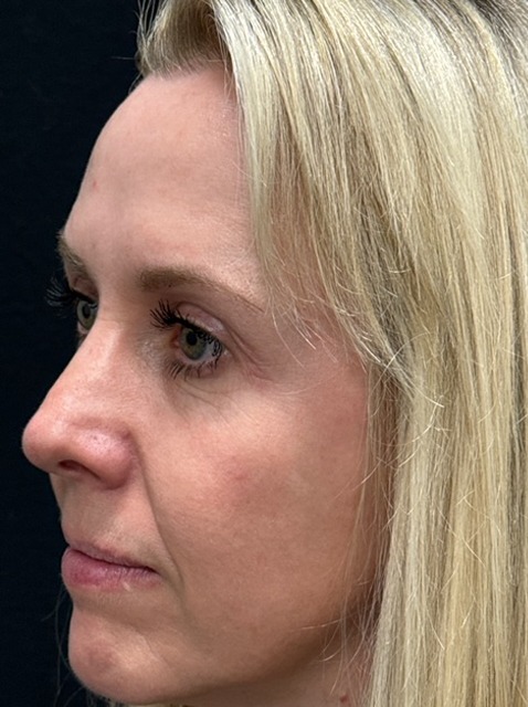 Rhinoplasty before and after - after