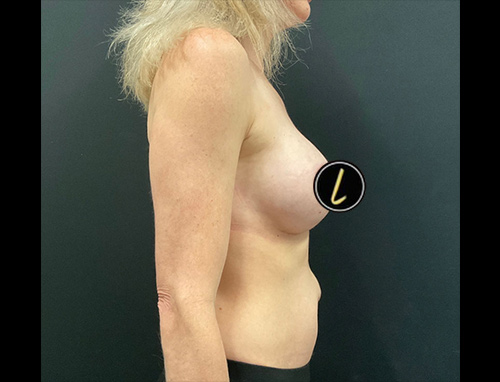 Breast Augmentation before and after - after