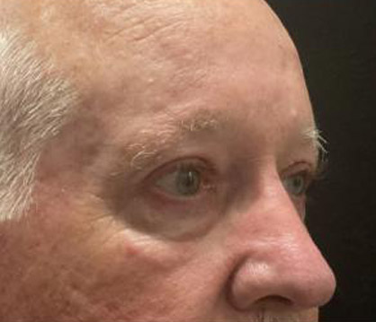 Male Blepharoplasty before and after - after