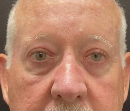Male Blepharoplasty before and after - after