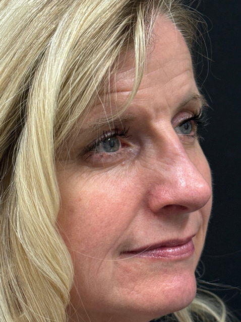 Rhinoplasty before and after - after