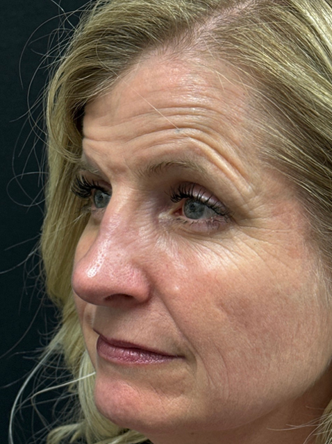 Rhinoplasty before and after - after