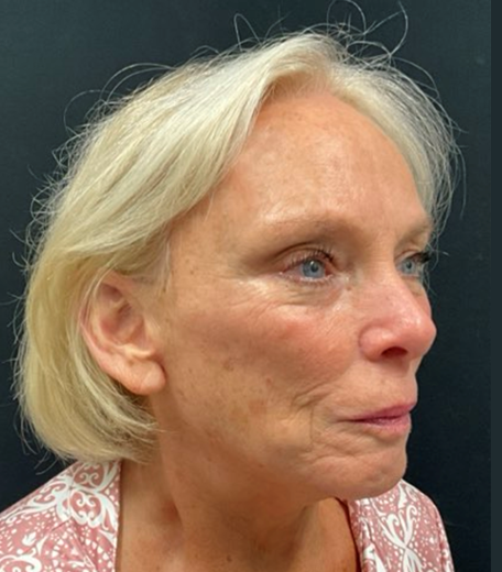Facelift before and after - after