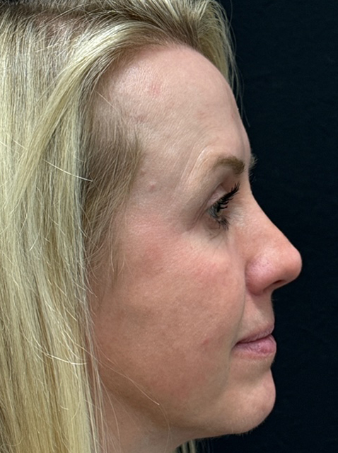 Rhinoplasty before and after - after