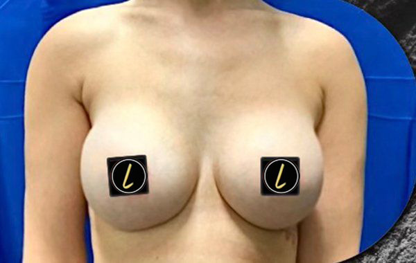 Breast Augmentation before and after - after
