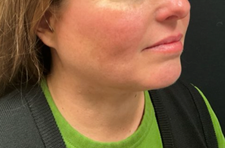 Facelift before and after - after