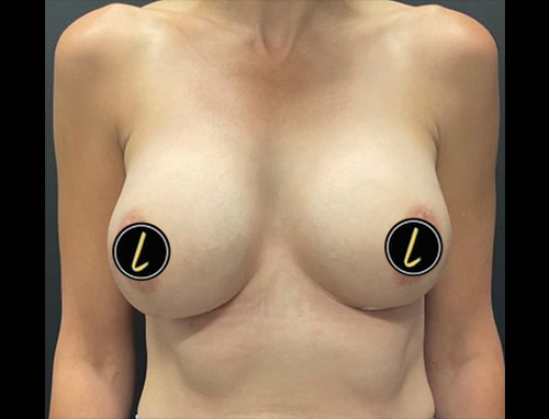 Breast Augmentation before and after - after
