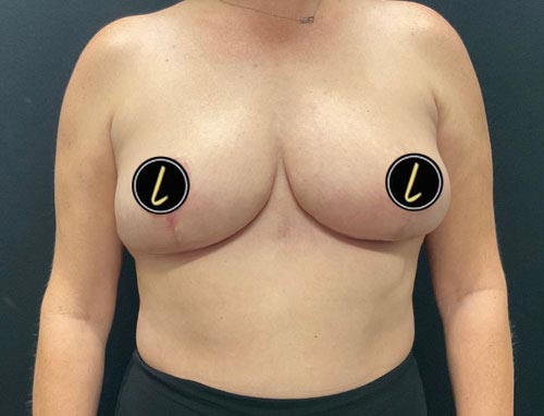 Breast Reduction before and after - after