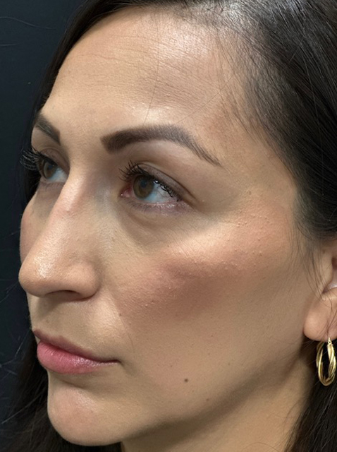 Rhinoplasty before and after - after