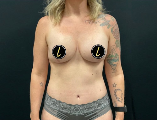 Mommy Makeover before and after - after