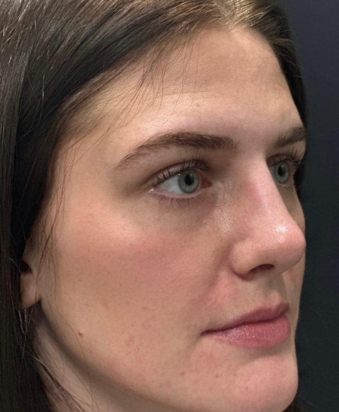 Rhinoplasty before and after - after