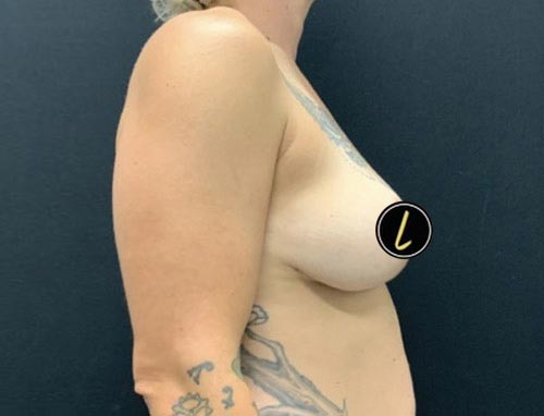Breast Reduction before and after - after