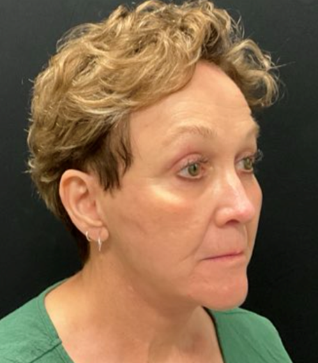 Facelift before and after - after
