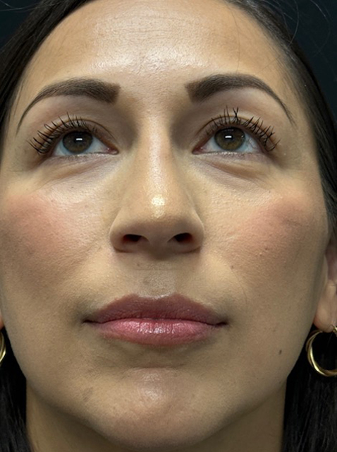 Rhinoplasty before and after - after