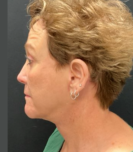 Facelift before and after - after