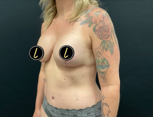 Mommy Makeover before and after - after