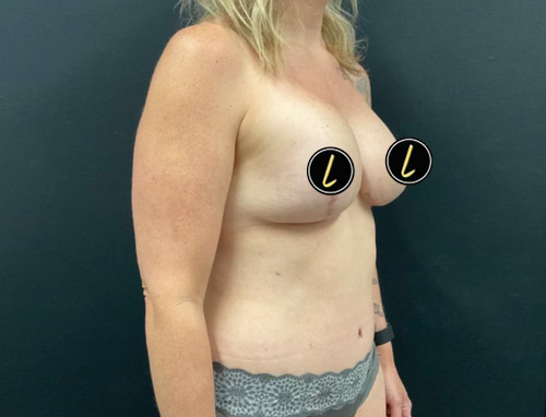 Mommy Makeover before and after - after