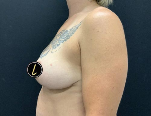 Breast Reduction before and after - after