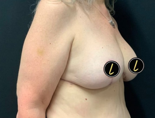 Breast Revision before and after - after