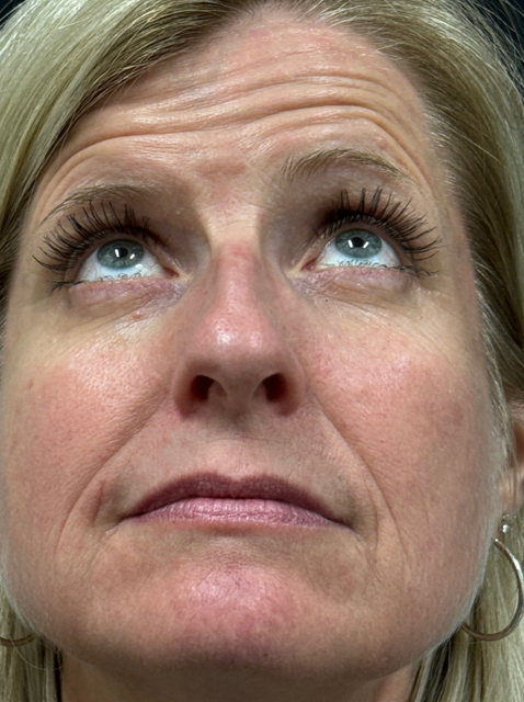 Rhinoplasty before and after - before