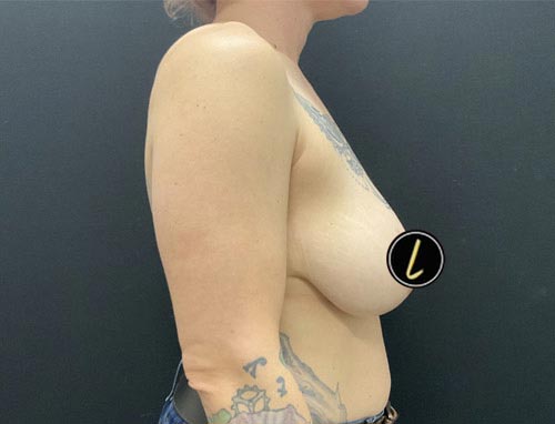Breast Reduction before and after - before