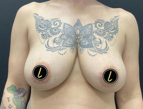 Breast Reduction before and after - before
