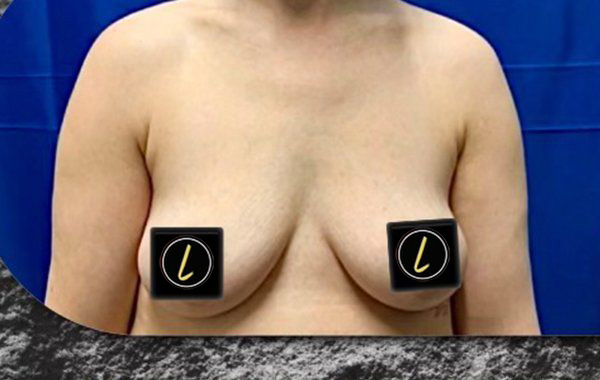 Breast Augmentation before and after - before