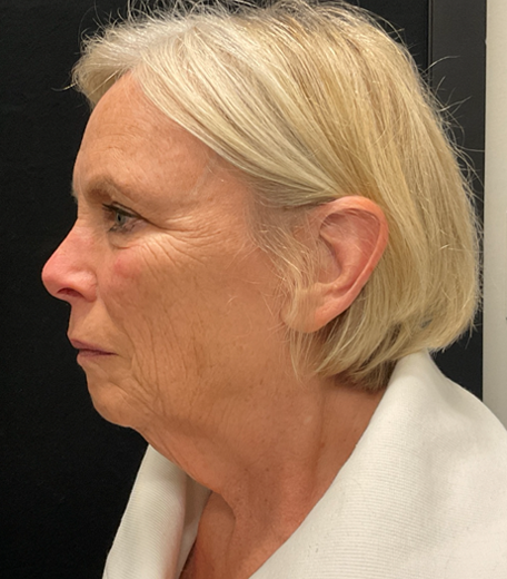 Facelift before and after - before