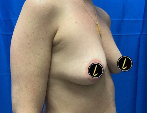 Breast Augmentation before and after - before