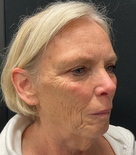 Facelift before and after - before