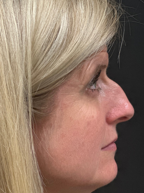 Rhinoplasty before and after - before
