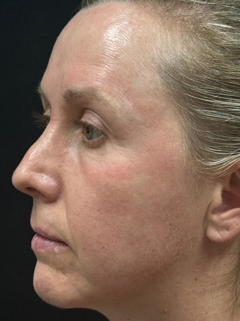 Rhinoplasty before and after - before