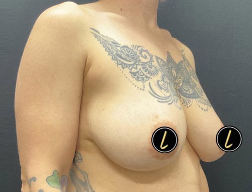 Breast Reduction before and after - before