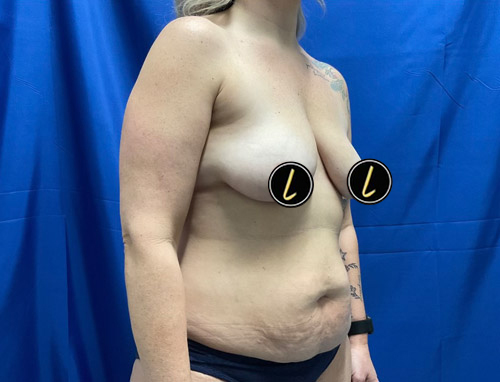 Mommy Makeover before and after - before