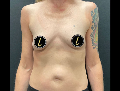 Breast Augmentation before and after - before