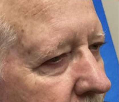 Male Blepharoplasty before and after - before