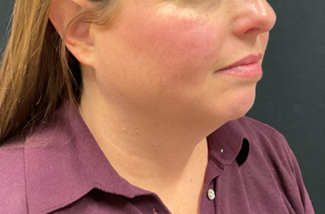 Facelift before and after - before