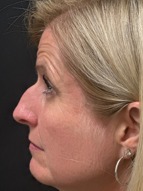 Rhinoplasty before and after - before