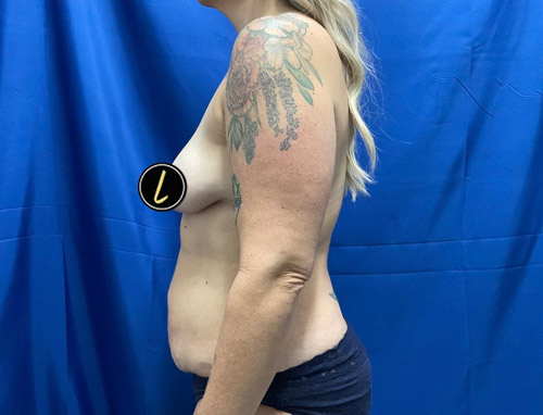 Mommy Makeover before and after - before