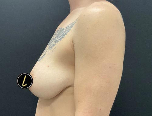 Breast Reduction before and after - before