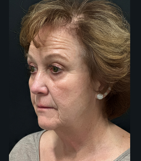 Facelift before and after - before