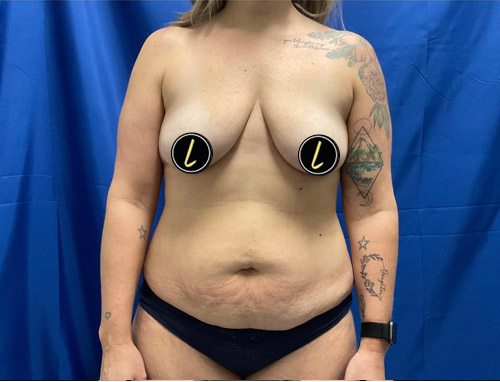 Mommy Makeover before and after - before