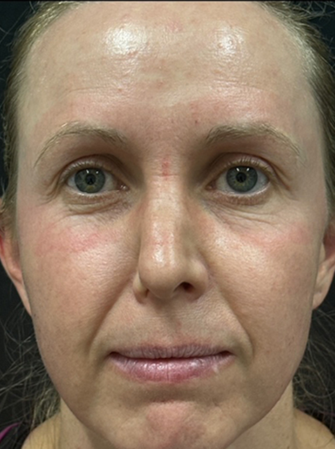 Rhinoplasty before and after - before